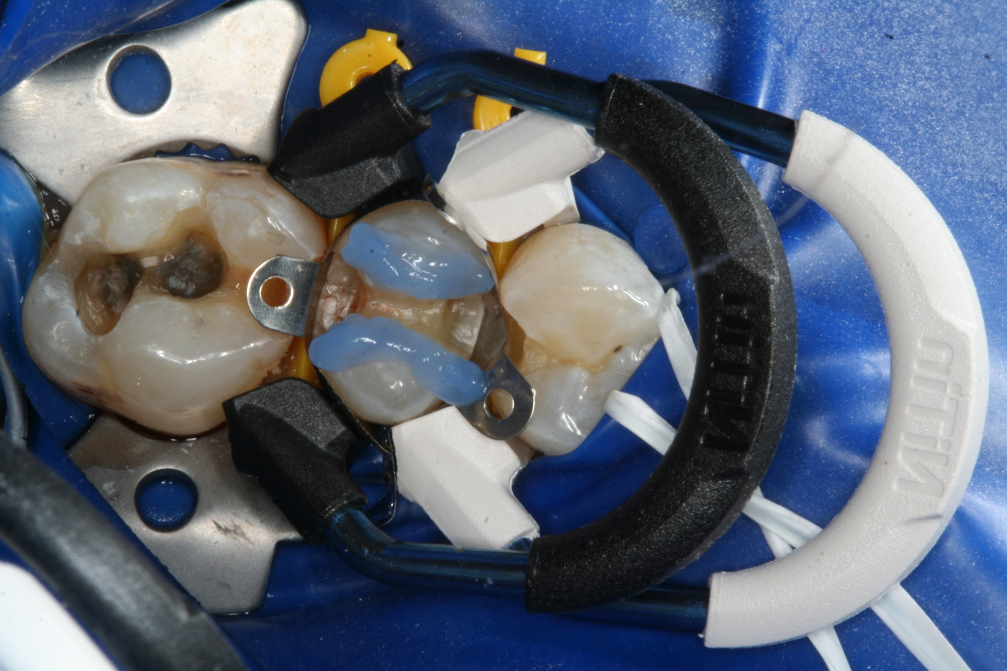 NiTin™ Sectional Matrix Separator Rings